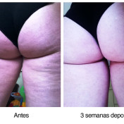 Celulite Antes e Depois
