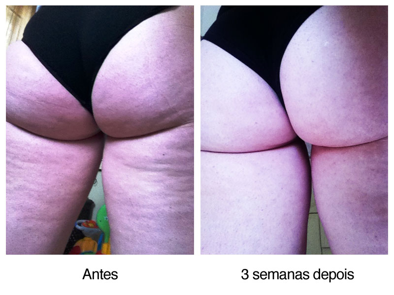 Celulite Antes e Depois